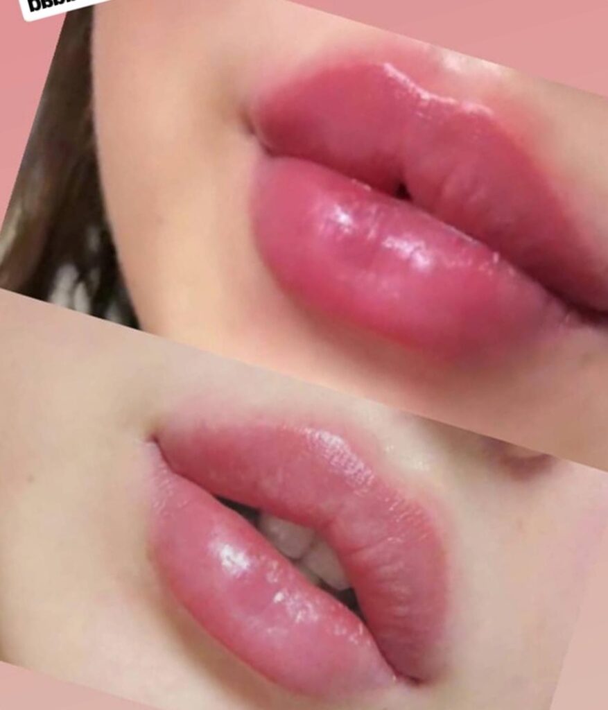 Burun Çene ve Elmacık Dolgusu ile Yüz Estetiği