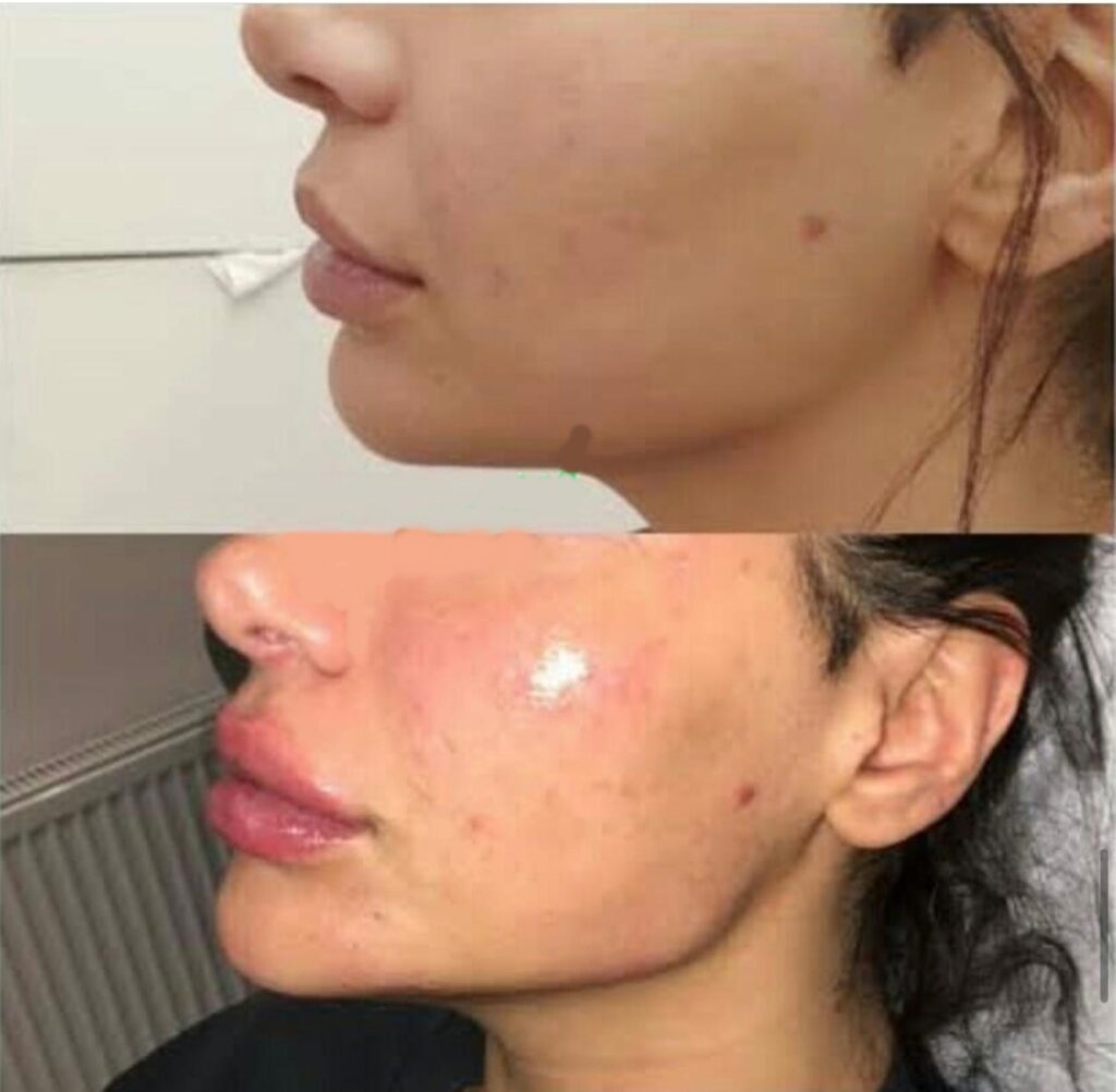 Kalıcı Fondöten Kaş Laminasyonu ve Dudak Kontürü